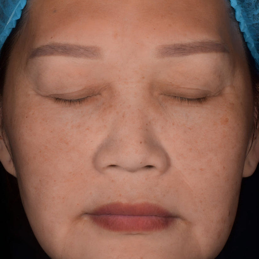 After treatment