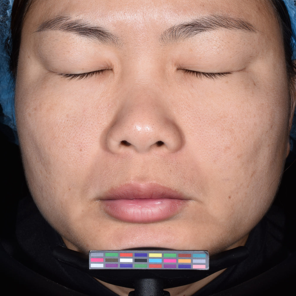 After treatment