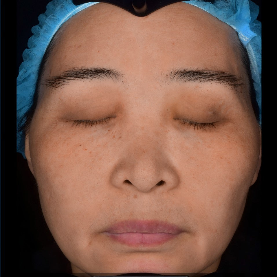 After treatment