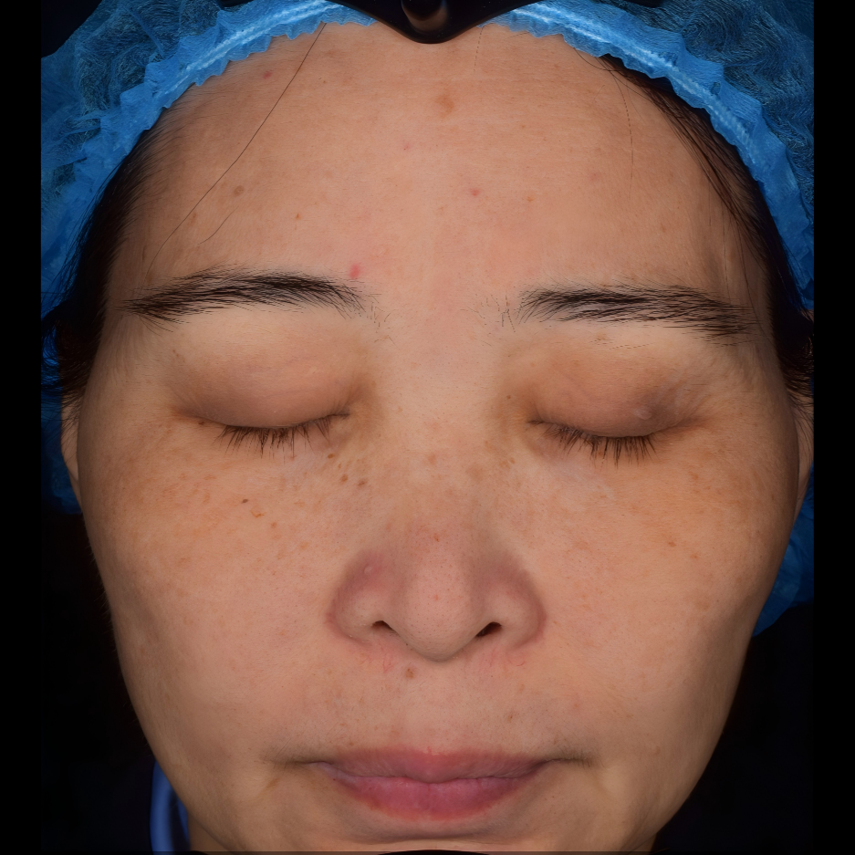 Before treatment