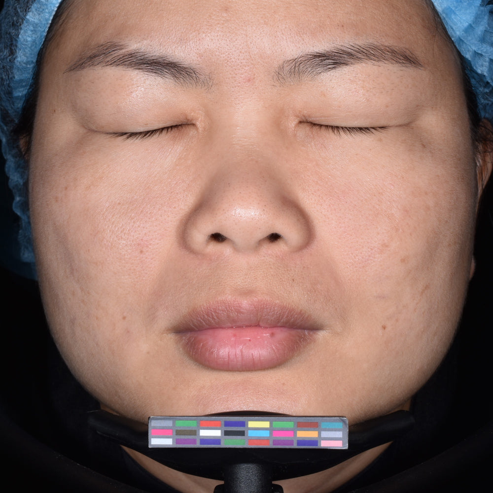 Before treatment