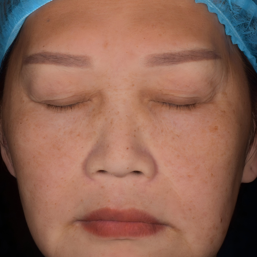 Before treatment